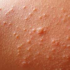 heat rash pictures symptoms causes