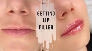 getting lip filler russian lips