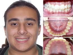 If you need to correct crowded or crooked teeth, traditional braces are one of the most tried and. What Is Crowding Symptoms Diagnosis And Treatment