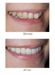 fix and straighten teeth without braces