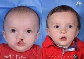 cleft lip repair before after photos
