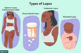 Lupus (or sle) is a complex disease. Lupus Treatment Options