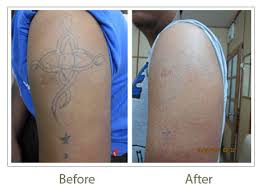 laser tattoo removal in delhi