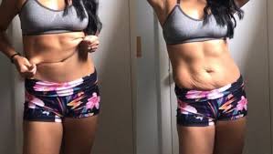 loose skin after weight loss does it