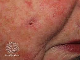 pictures of melanoma and other skin cancers