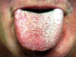 Coated White Tongue Foul Mouth What Yucky Signs Say About
