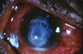 Cornea And Ocular Surface