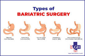 types of bariatric surgery types of