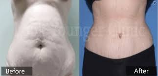 tummy tuck cost 2500 look younger clinic