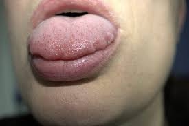 red dots on tongue causes symptoms