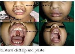 lip reduction surgery delhi best lip