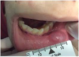 excision of lower lip mucocele
