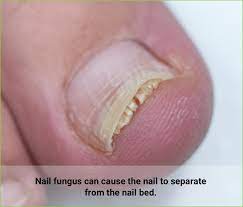 about toenail fungus