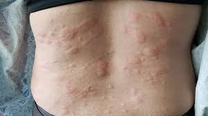 hives symptoms what they look like