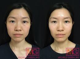 Other brands are available and work much that same way botox does, including vistabel, dysport. Botox For Tmj Nyc Botox For Temporomandibular Joint Jaw Area