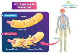 guillain barre syndrome causes