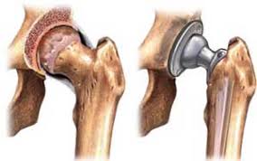 advanced hip replacement surgery in