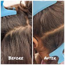 best lice treatment for s in