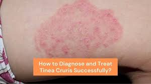 how to diagnose and treat tinea cruris