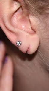 split ear repair hurren consultant