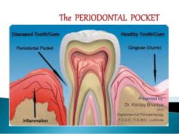 Periodontal Pocket