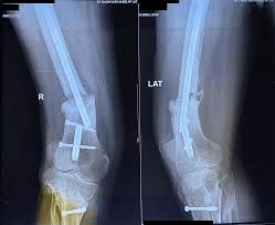 non union distal femur fractures