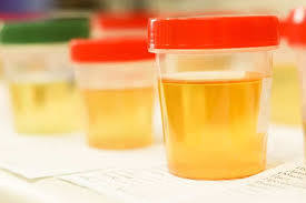 your urine is bright yellow