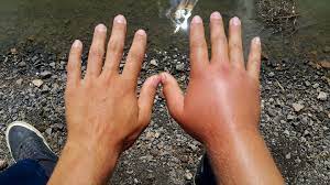 swollen fingers and hands