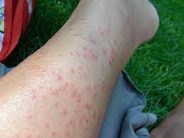 causes of summer rashes and how to