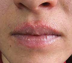 allergic contact cheilitis from a