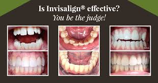 Have you noticed that your invisalign trays don't seem to be fitting properly onto your teeth? How Long Does Invisalign Take Discovery Dental