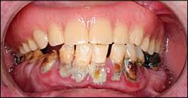 Go to the dentist asap! Common Dental Infections In The Primary Care Setting American Family Physician