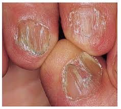 nail disorders chapter 58