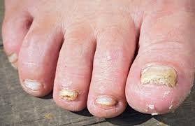 toenail fungus causes
