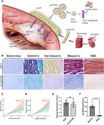 • rupture or erosion of coronary artery plaque can produce prolong. An Off The Shelf Artificial Cardiac Patch Improves Cardiac Repair After Myocardial Infarction In Rats And Pigs Science Translational Medicine