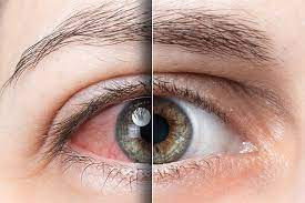 red eyes causes and treatment for