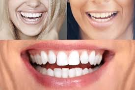 What are the real causes? Crooked Lower Teeth 5 Effortless Steps To Get Them Realigned