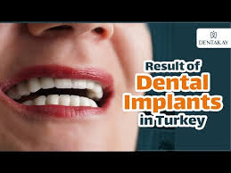 full mouth dental implants cost 3