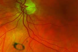 To evaluate the condition, an ophthalmologist dilates the eye to examine it and make sure there is no retinal tear or detachment. Degenerative Floaters A Practical Review Mivision