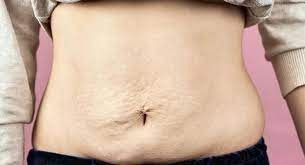 fibrosis after liposuction causes