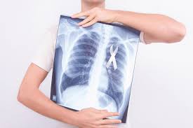 Many times, symptoms do not manifest themselves in the early stages of lung cancer. Can You Have Lung Cancer With No Symptoms Lung Cancer Pintas Mullins Law Firm