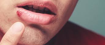 what is the treatment for cold sores