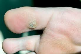 plantar warts can cause foot pain