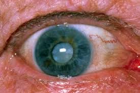 age cataracts nhs