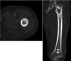 pathologic fracture of the long bone