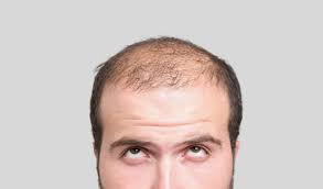 hair loss propecia carries risk of