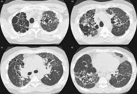 Pulmonary Hypertension  First Guidelines Issued for Children resume examples Dilated Main Pulmonary Artery due to Pulmonary Hypertension   CTisus CT  Scanning
