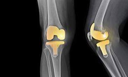 knee replacement surgery risks and