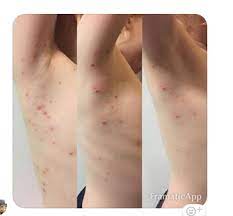 What makes the rash and lesions of molluscum contagiosum distinctive? Molluscum Contagiosum Children 217 Testimonials A Medical Doctor S Guide To Wheatgrass Healing