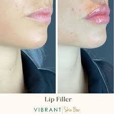 hyaluronic acid lip fillers everything